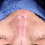 Rhinoplasty Before & After Patient #1013