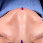 Rhinoplasty Before & After Patient #1013