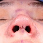 Rhinoplasty Before & After Patient #1014