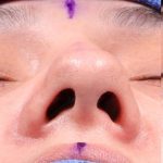 Rhinoplasty Before & After Patient #1014