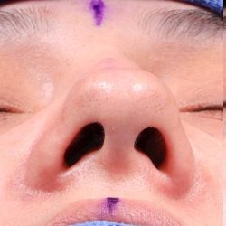 Rhinoplasty Before & After Patient #1014