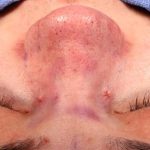 Rhinoplasty Before & After Patient #1014