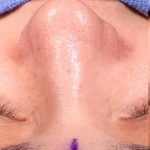 Rhinoplasty Before & After Patient #1014