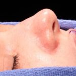 Rhinoplasty Before & After Patient #1014