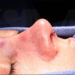 Rhinoplasty Before & After Patient #1014