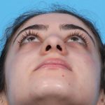 Rhinoplasty Before & After Patient #1015