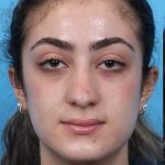 Rhinoplasty Before & After Patient #1015
