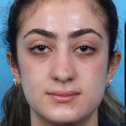 Rhinoplasty Before & After Patient #1015