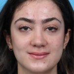 Rhinoplasty Before & After Patient #1015