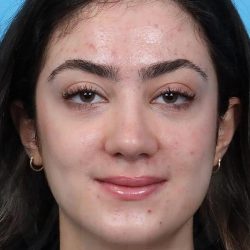 Rhinoplasty Before & After Patient #1015