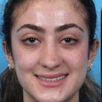 Rhinoplasty Before & After Patient #1015