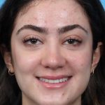 Rhinoplasty Before & After Patient #1015