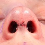 Rhinoplasty Before & After Patient #1018