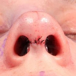 Rhinoplasty Before & After Patient #1018