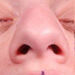 Rhinoplasty Before & After Patient #1018