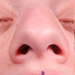 Rhinoplasty Before & After Patient #1018