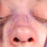 Rhinoplasty Before & After Patient #1018