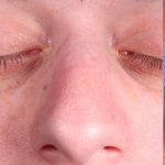 Rhinoplasty Before & After Patient #1018
