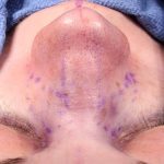 Rhinoplasty Before & After Patient #1018