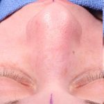 Rhinoplasty Before & After Patient #1018