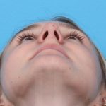 Rhinoplasty Before & After Patient #1019