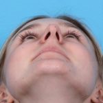 Rhinoplasty Before & After Patient #1019