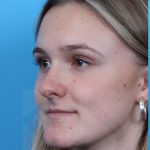 Rhinoplasty Before & After Patient #1019
