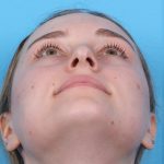 Rhinoplasty Before & After Patient #1020