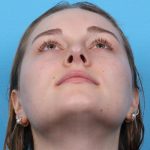 Rhinoplasty Before & After Patient #1020