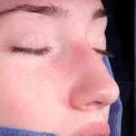 Rhinoplasty Before & After Patient #1121