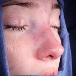 Rhinoplasty Before & After Patient #1121