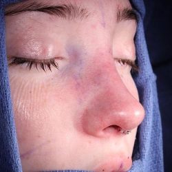 Rhinoplasty Before & After Patient #1121