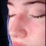 Rhinoplasty Before & After Patient #1121