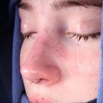 Rhinoplasty Before & After Patient #1121