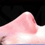 Rhinoplasty Before & After Patient #1121