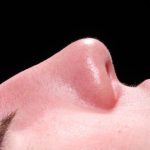 Rhinoplasty Before & After Patient #1121