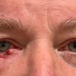 Eyelid Reconstruction Before & After Patient #1211
