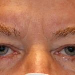 Eyelid Reconstruction Before & After Patient #1211