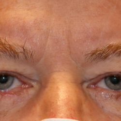 Eyelid Reconstruction Before & After Patient #1211