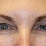 Eyelid Retraction Before & After Patient #1213