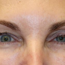 Eyelid Retraction Before & After Patient #1213