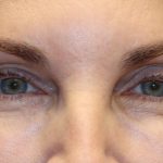 Eyelid Retraction Before & After Patient #1213