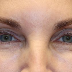 Eyelid Retraction Before & After Patient #1213