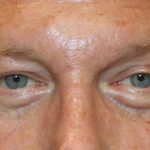 Lower Blepharoplasty Before & After Patient #1218