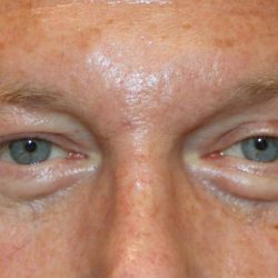 Lower Blepharoplasty Before & After Patient #1218
