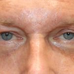 Lower Blepharoplasty Before & After Patient #1218
