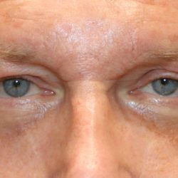 Lower Blepharoplasty Before & After Patient #1218