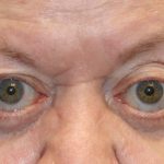 Orbital Decompression Before & After Patient #1229