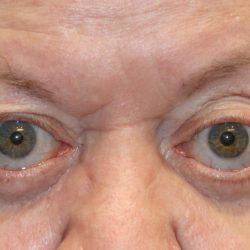 Orbital Decompression Before & After Patient #1229