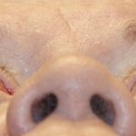 Orbital Decompression Before & After Patient #1229
